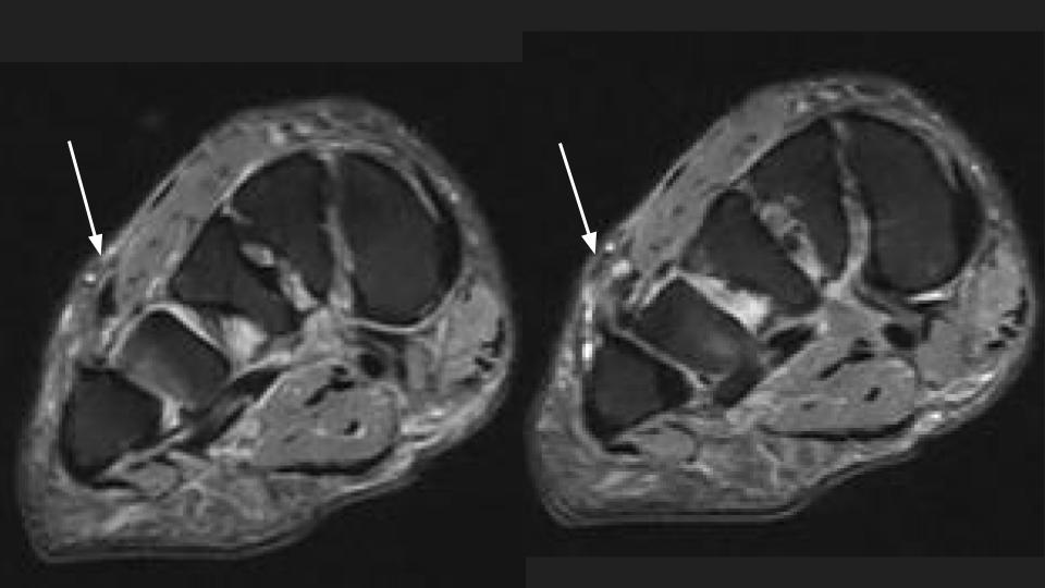 Figure 2 for case peroneus tertius ( RID2915 )